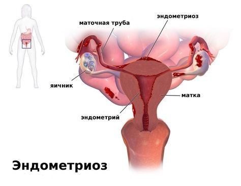 Эндометриоз матки - загадочная болезнь