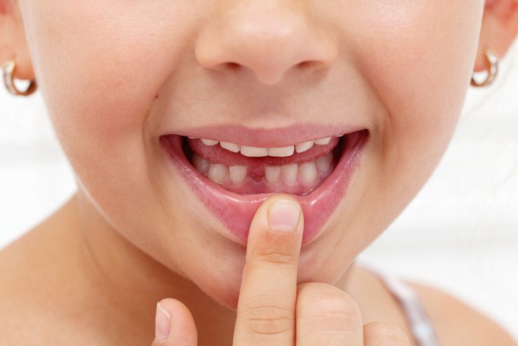 Удаление молочных зубов у детей: показания и осложнения