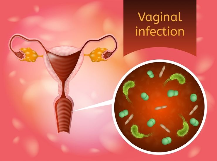 Причины возникновения вагинита