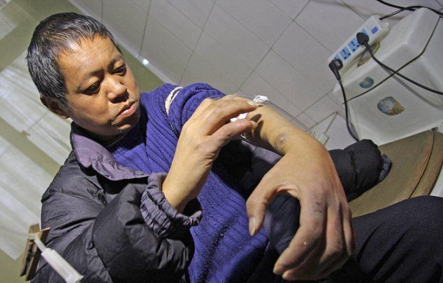 Китаец 13 лет очищает себе кровь с помощью самодельного аппарата для гемодиализа