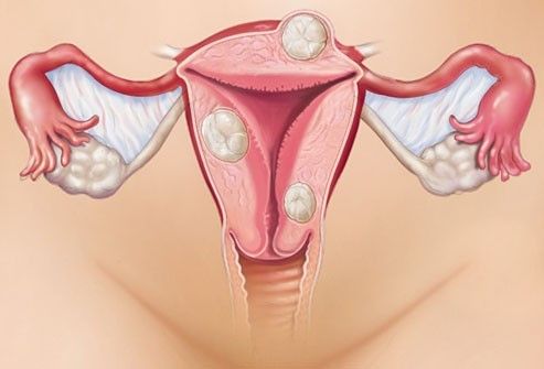 удаление эндометриоза матки