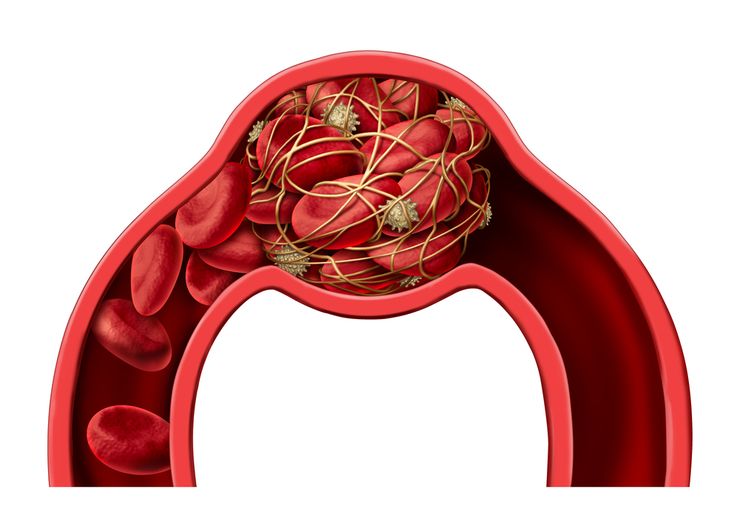 эмболизация маточных артерий