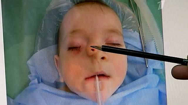 Новосибирские врачи избавили 11-месячного ребёнка от редчайшего врождённого заболевания