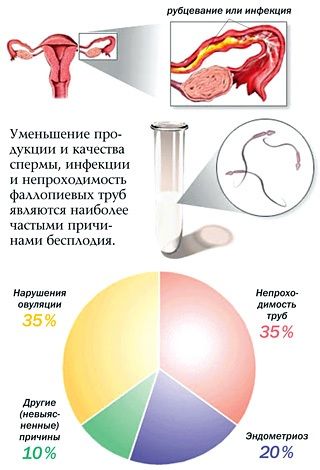 бесплодие