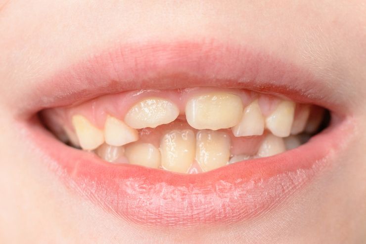 Нижние кривые зубы фото