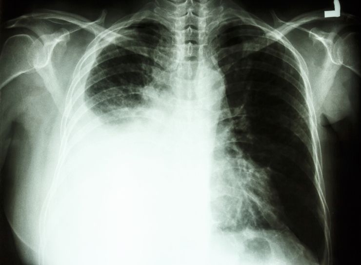 симптомы рака и рентгенология