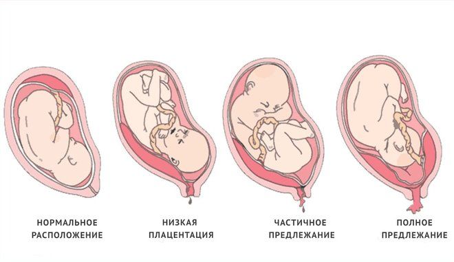 расположение плаценты при беременности
