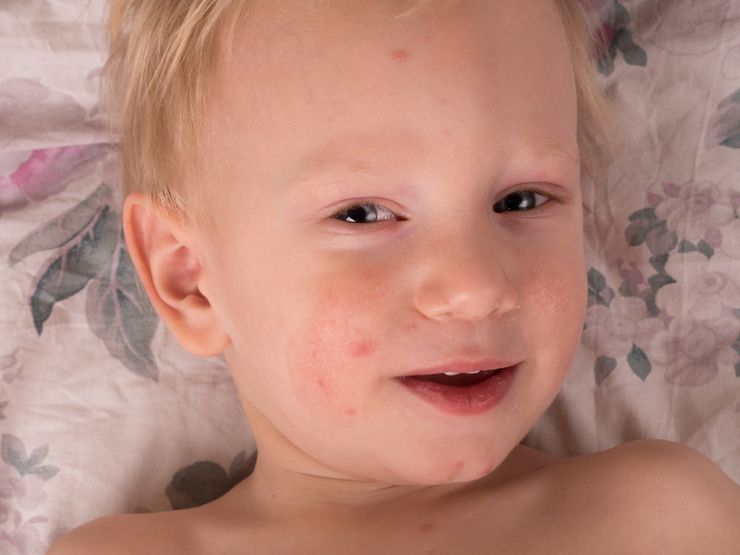 аллергия на сладкое у детей