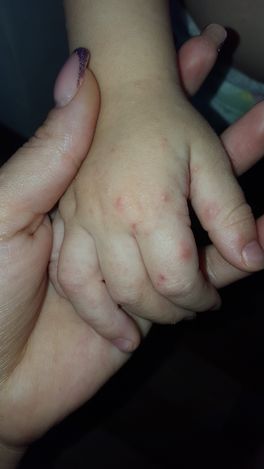 Срооочно помогите сыпь Срооочно помогите сыпь